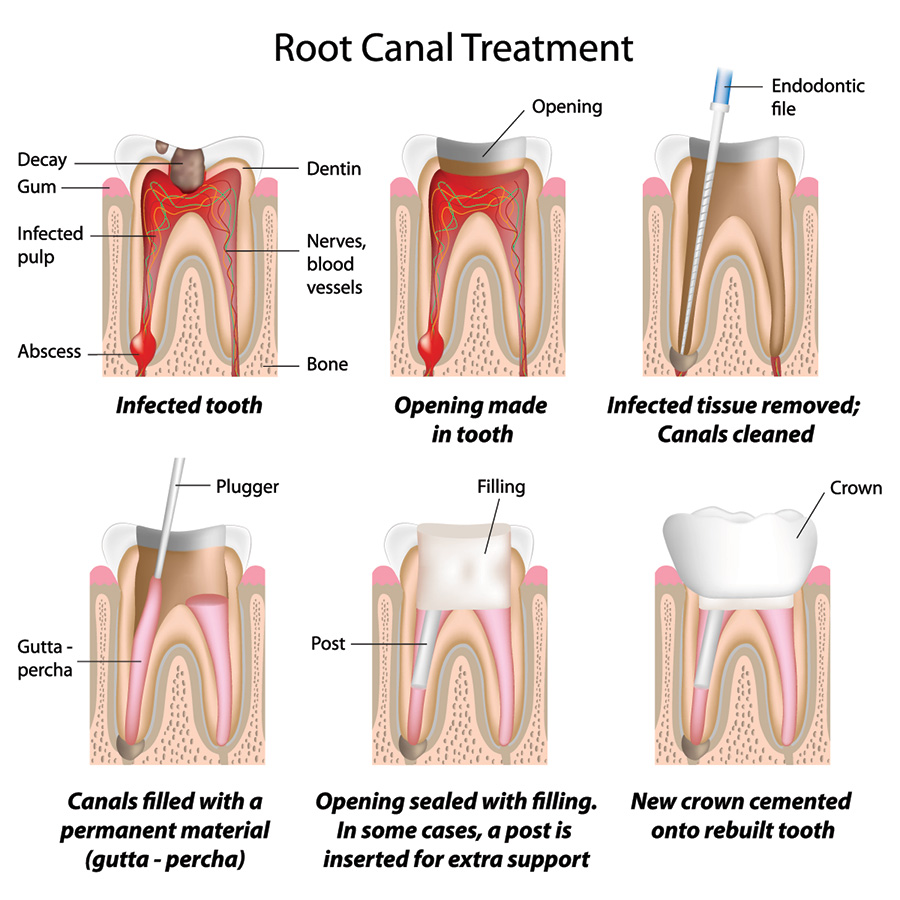 12045569_xxl-RootCanal