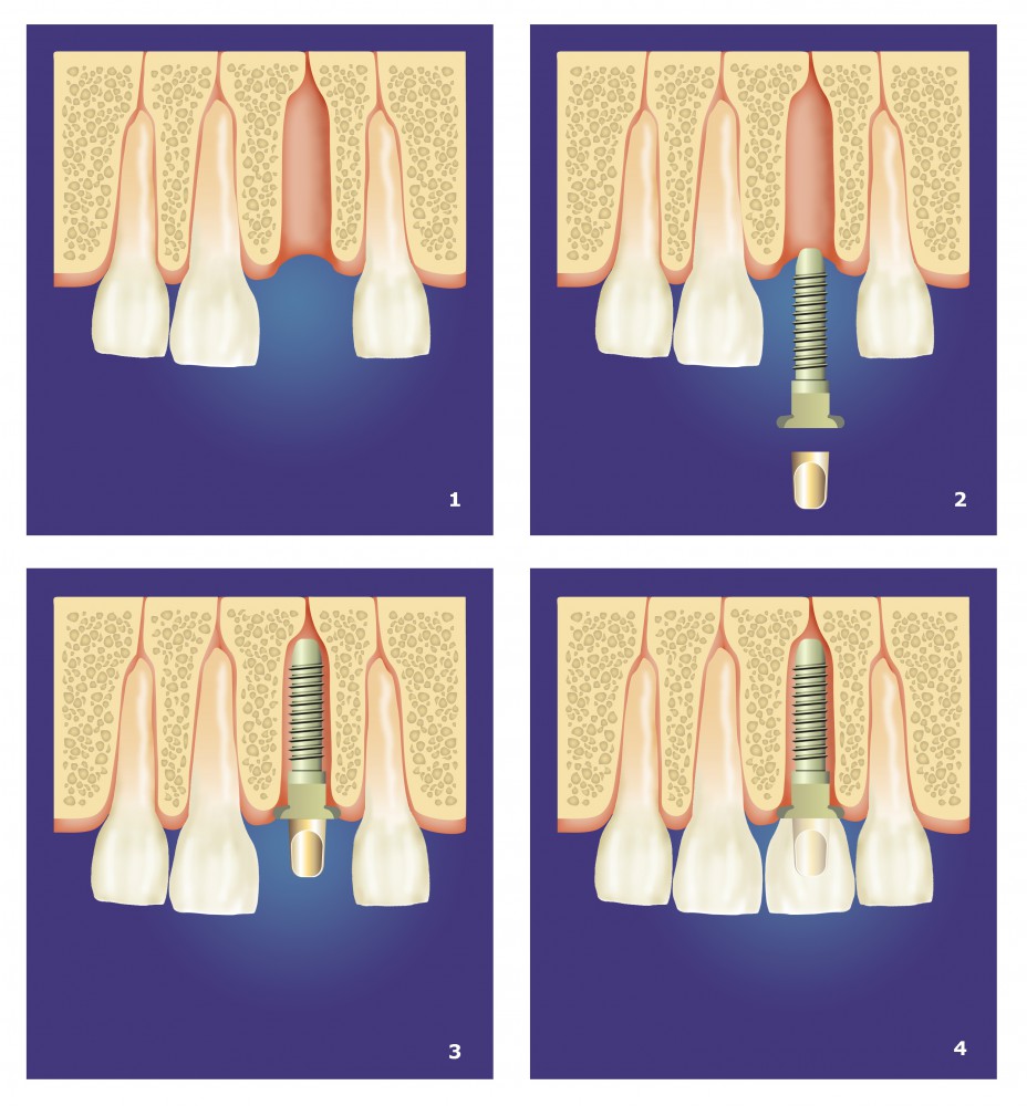 16492053_xxl-dental prosthesis intervention in four steps implantology